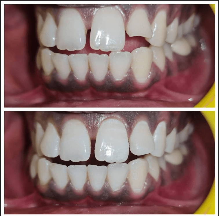 Teeth Adjustment Before & After