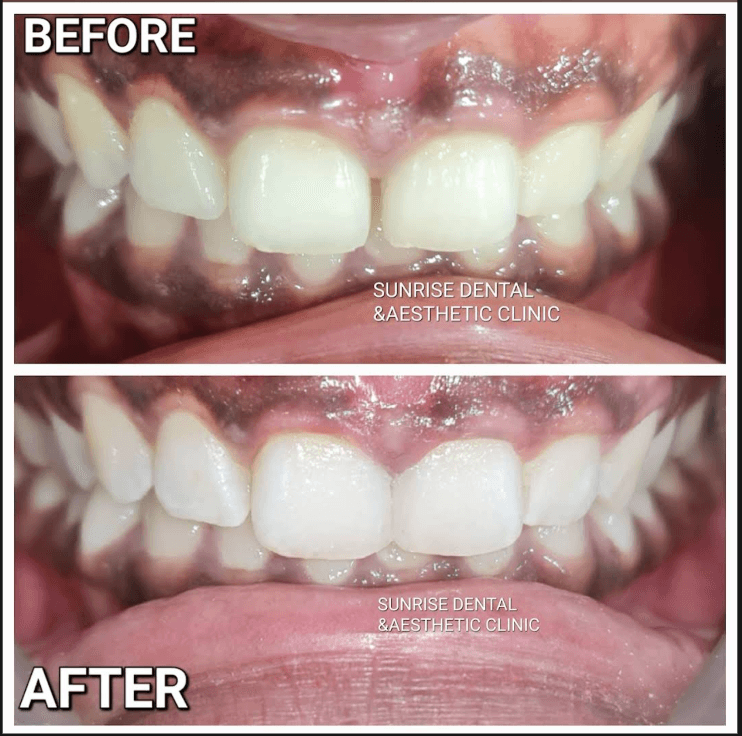 Cavities Cleaning Before & After