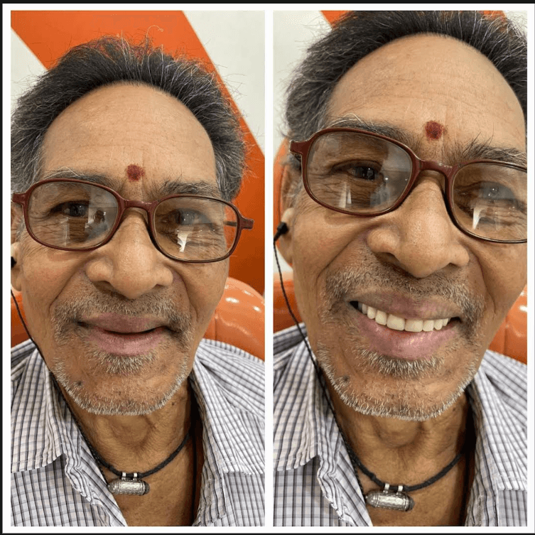 Teeth Replacement Before & After