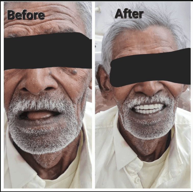 Teeth Replacement 2 Before & After